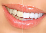 Teeth Whitening Gel Pen